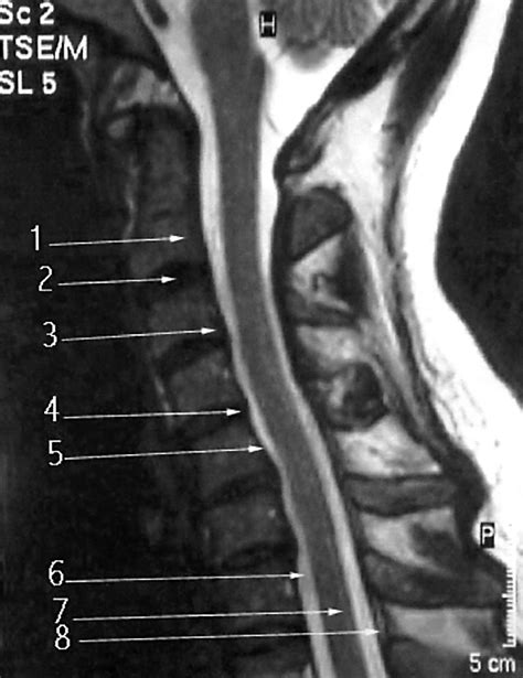 cervical spine cord test